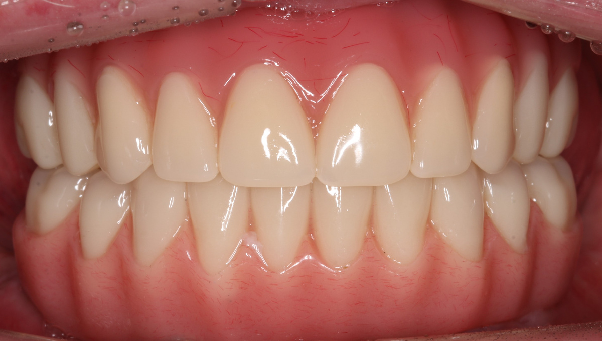 На верхней и нижней челюсти фиксированы адаптационные протезы. Они из акрила, внутри – армирующая балка.