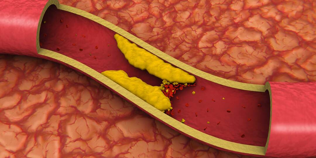 Можно ли очистить сосуды от бляшек без операции? Что говорит медицина — подробный разбор