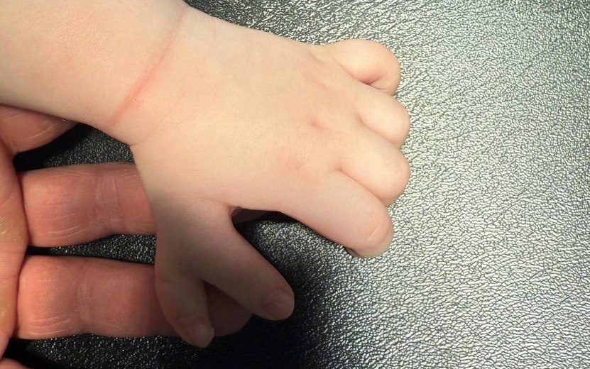    Малыша с 12 пальцами на руках прооперировали в Ижевске