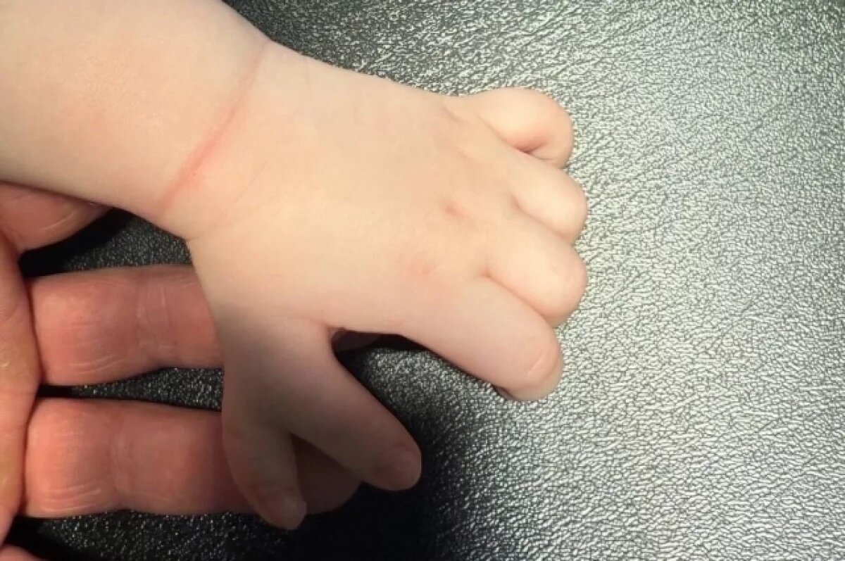    В Ижевске прооперировали малыша, у которого на руках было по шесть пальцев