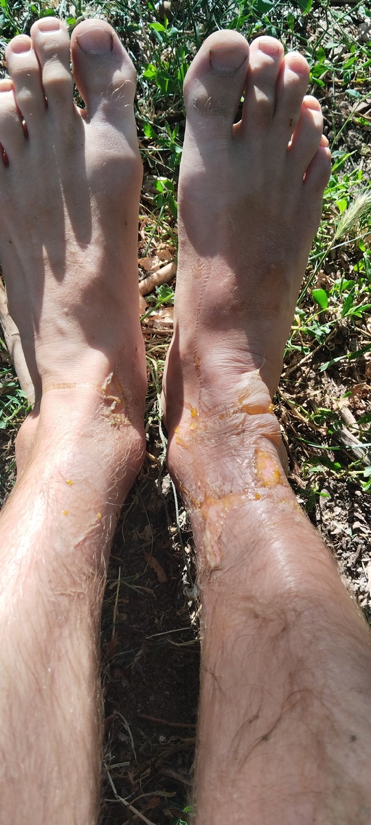 Ожог 2 степени