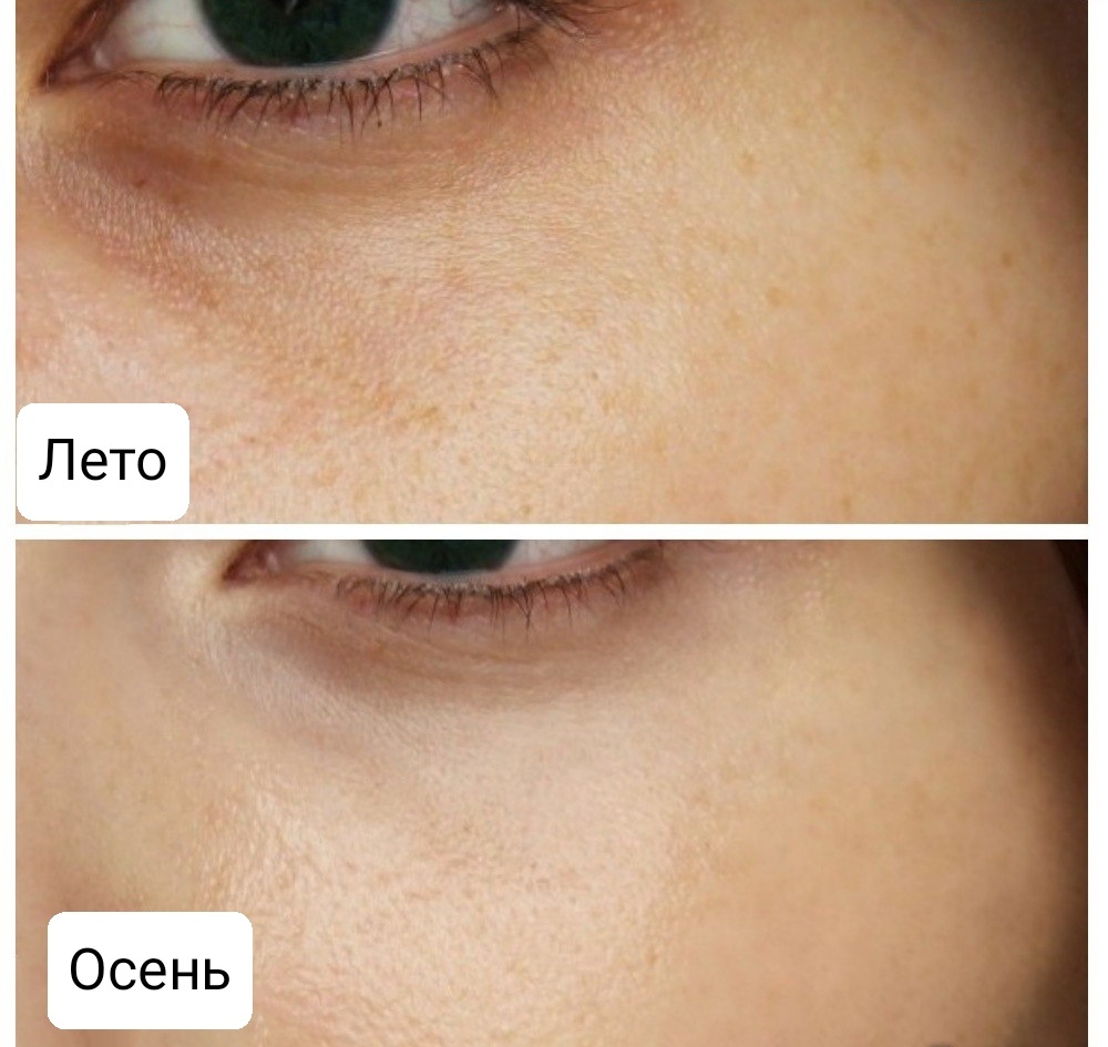 Сейчас за лето у меня минимальные "потери", при том что моя кожа очень склонна к пигментации. Такие пятнышки проходят сами к октябрю. Раньше каждое лето появлялись огромные темные пятна.