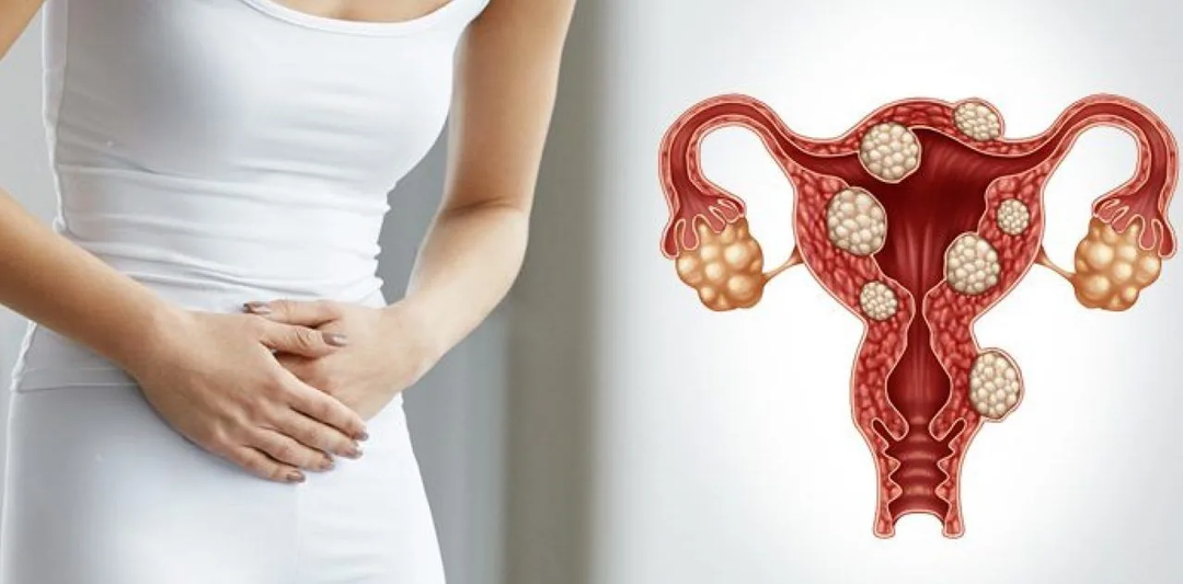 Это не рак, но риски все же есть: врач рассказала, что такое миома матки, насколько она опасна?