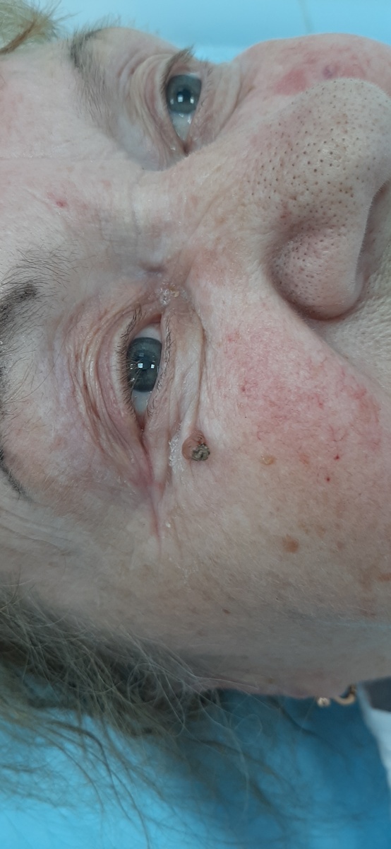 На представленном фото состояние перед операцией. Кроме новообразования, расположенного ниже нижнего века, хорошо различимы две кератомы на коже правой щеки.