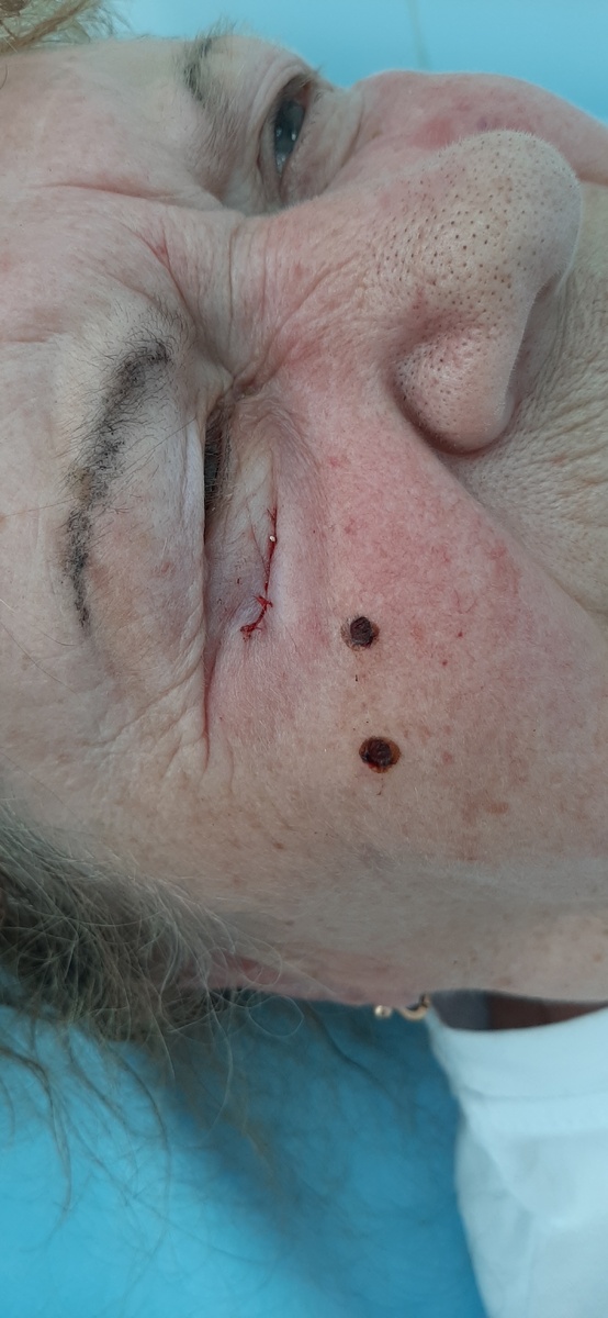 На фото после операции на фоне отечности кожи (это результат анестезии) видна линия внутрикожного шва и две точки радиочастотного воздействия.