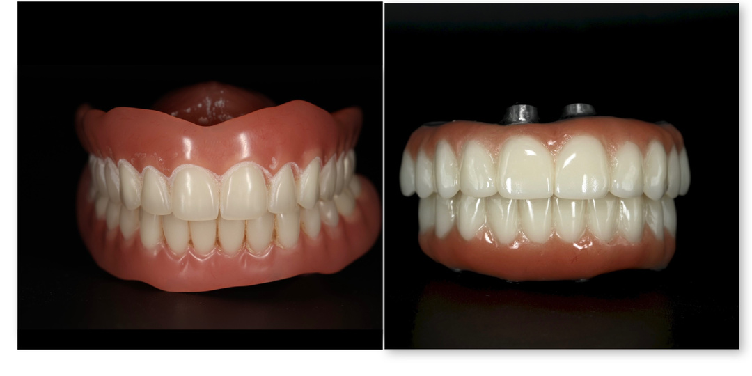 Инструкция по замене съёмных протезов на протезы на имплантатах. "All-on-6" 2 челюсти - от особенностей диагностики до коротких зубных рядов