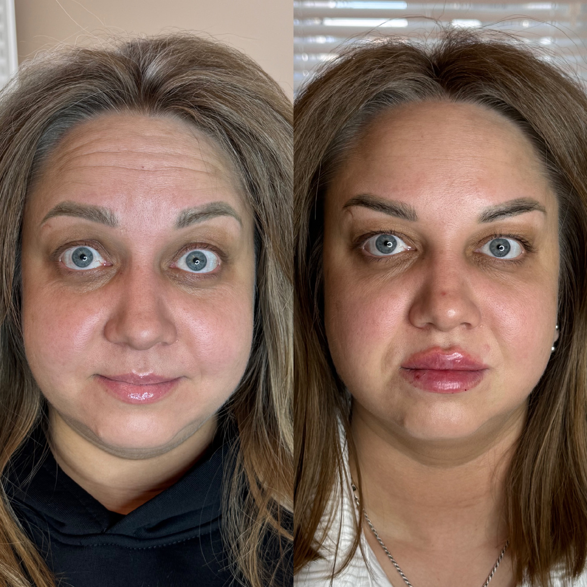 Комплексное преображение всегда даёт преображение за короткий  промежуток времени . 
 🔺Ботулинотерапия стирает крупные морщины с лица
 🔺Губы придают визуально молодость и сексуальность  лицу 
 🔺Работа с качеством кожи - полимолочная кислота дает видимый лифтинг эффект  сразу на 2 неделе.

На приеме я составляю план лечения Вашей кожи и омоложения Вашего лица .