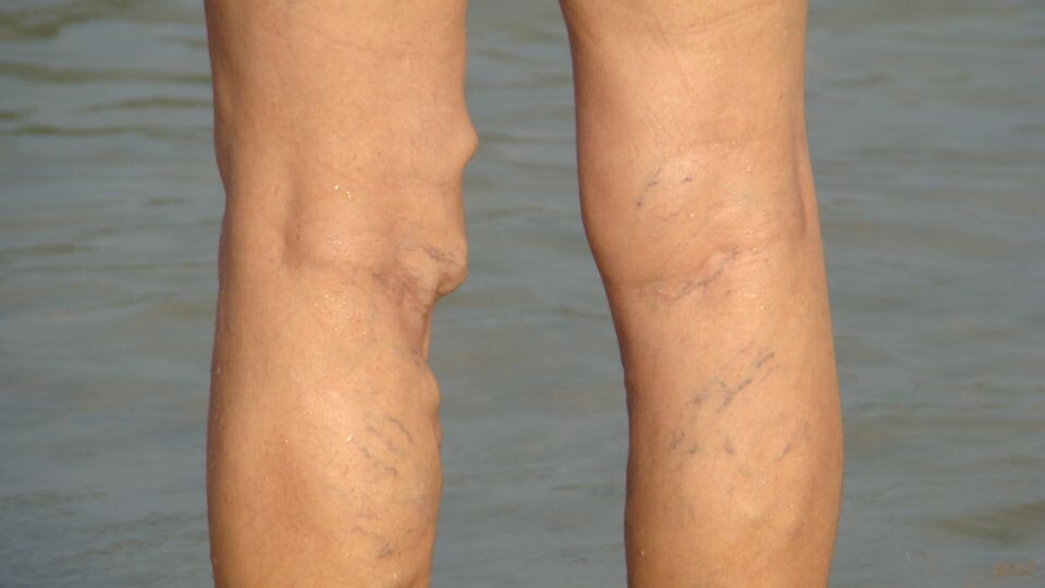 Выпирающие вены при варикозе