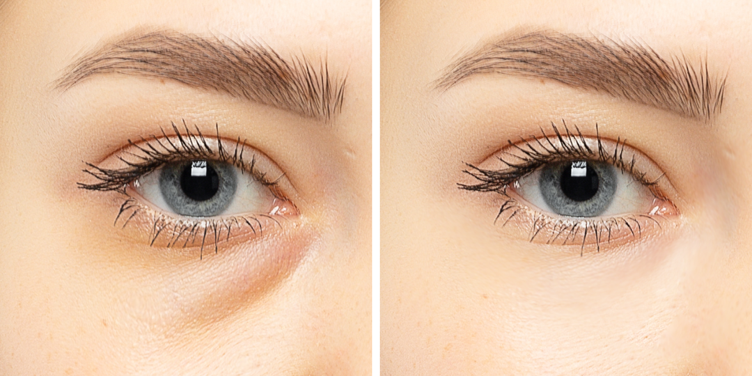 Упустила 3 причины отечности - как убрать мешки под глазами (5 простых приемов)