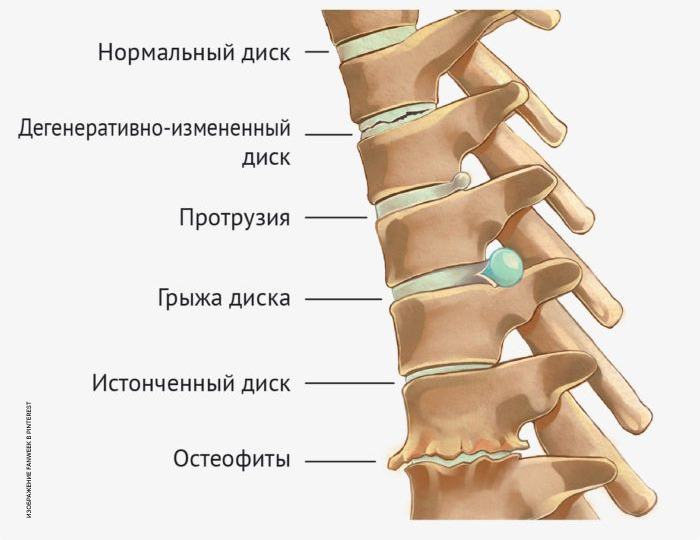 Дегенеративные заболевания позвоночника
