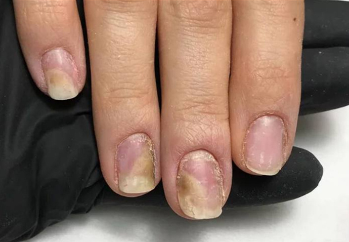 Онихолизис на пальцах рук