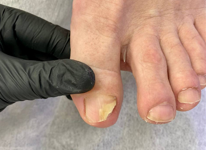 Онихолизис на большом пальце ноги