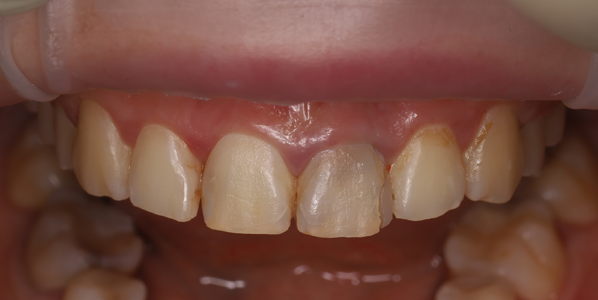 Фото нашей пациентки до эстетической реставрации с помощью виниров.
