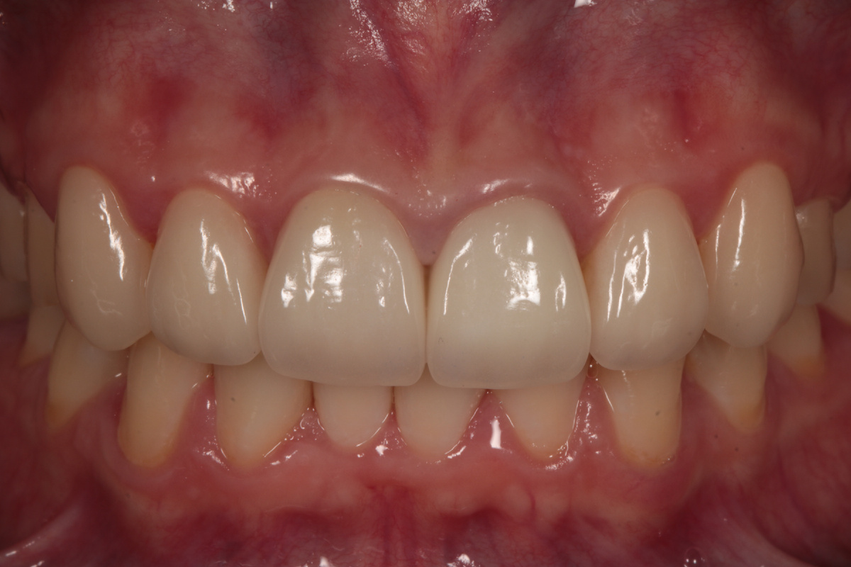 Фото нашей пациентки после эстетической реставрации с помощью виниров.