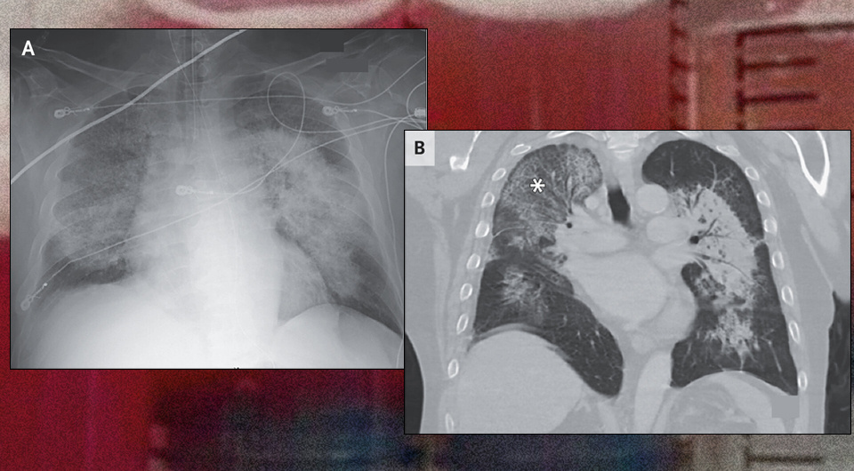   N + 1; Irene S. Lee / NEJM, 2025