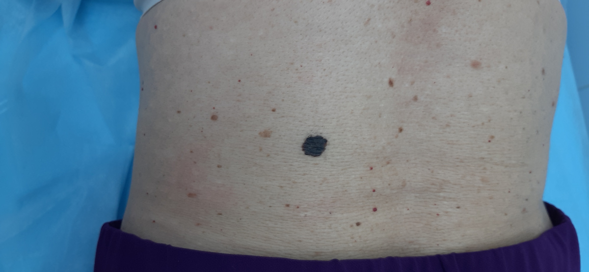 На представленном фото состояние перед операцией. Темное, с неровными контурами новообразование расположено на коже в поясничной области слева, над окружающей кожей не возвышается, размером до 7 мм.