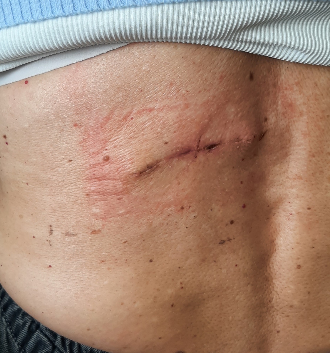 Через 17 дней после операции. Только что удалена поверхностная лигатура и внутрикожная нить. По обе строны от места, где располагалась центральная лигатура, сохраняются небольшие плотные сухие корки, отмечающая линию примыкания краёв кожи. 