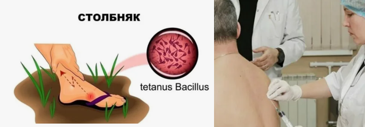 Прививка от столбняка взрослым делается под лопатку.  Нужна ли экстренная прививка от столбняка после пореза?