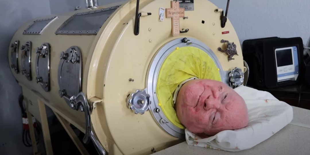 70 лет прожил в капсуле "железное легкое" Пол Александер дышал, учился и побеждал.