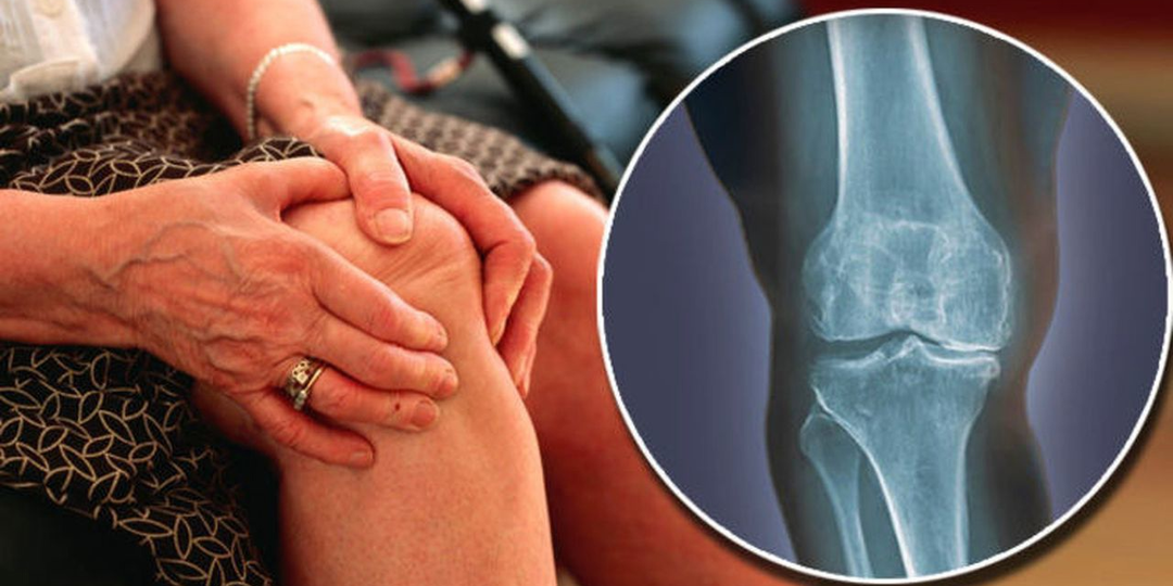 Артрит и артроз: битва за суставы — что опаснее и сложнее в лечении?