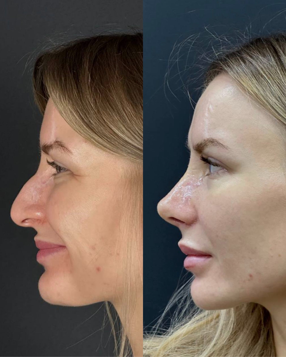 Риносептопластика🔥С момента операции прошла всего неделя 😍