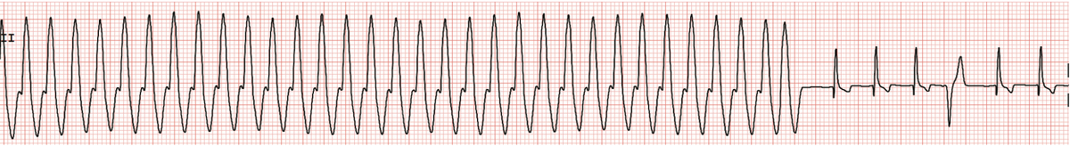 Электрокардиограмма, демонстрирующая желудочковую тахикардию (частота сердечных сокращений 260 ударов в минуту) у 7-летней самки боксёра с синдромом гипертрофической кардиомиопатии. Желудочковая эктопия имеет правостороннее происхождение. 