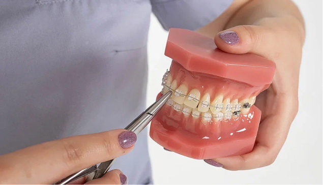 Почему брекеты ставят не сразу на обе челюсти: мнение ортодонтов клиники «Рестом» в Санкт-Петербурге