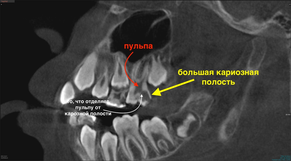 Зуб 26 - постоянный, глубокая кариозная полость