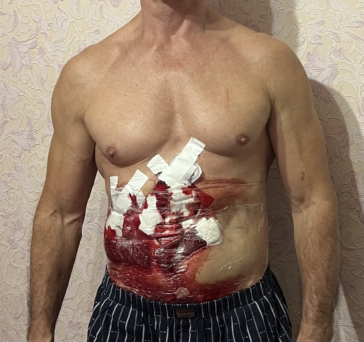 Гирудотерапия на печени.