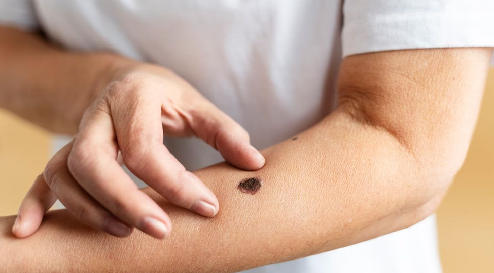 Это не только меланома — что важно знать о раке кожи