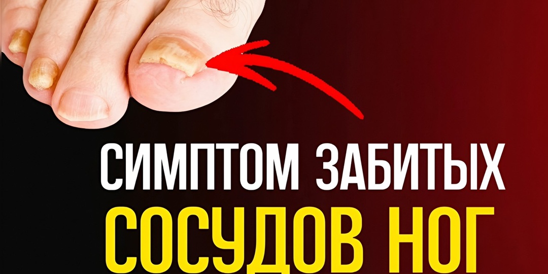 5 признаков забитых холестерином сосудов ног