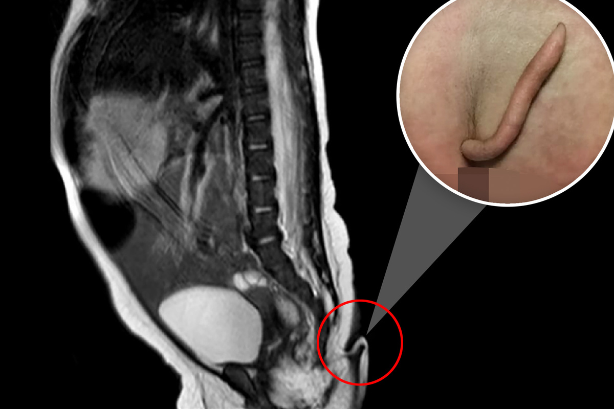 Рисунок 2. «Хвостовой» придаток у новорождённой девочки. Данные аномалии эмбрионального развития долгое время служили доказательством нашего звериного прошлого.