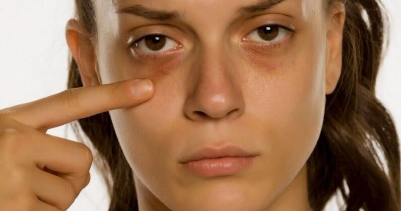 Тёмные круги под глазами — почему появляются и что делать