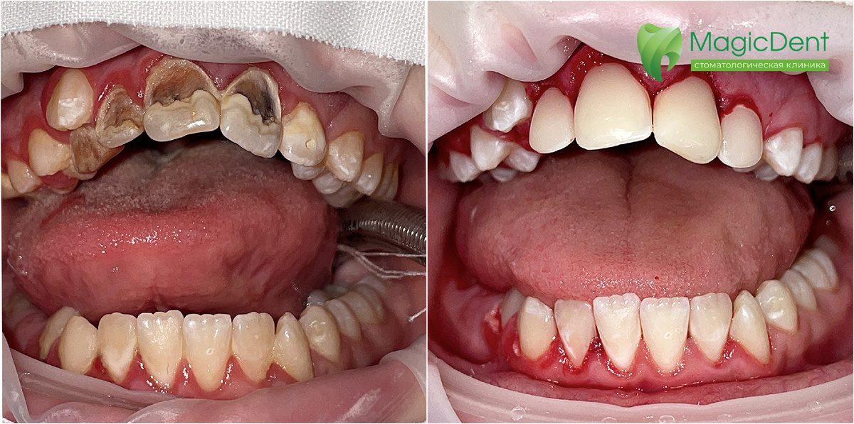 Результаты лечения зубов у детей под наркозорм