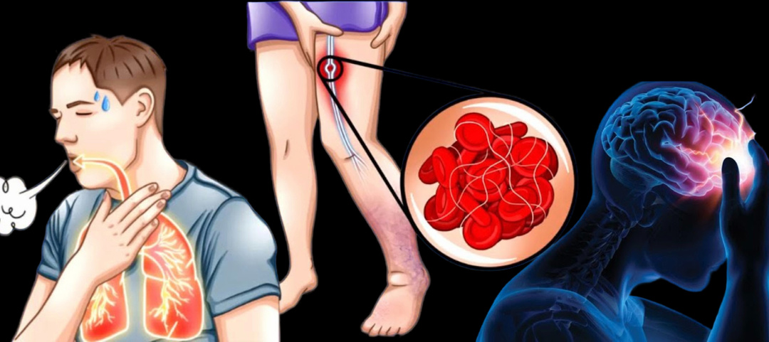 Экстренные меры: Что делать прямо сейчас при подозрении на тромб (алгоритм действий до приезда скорой)