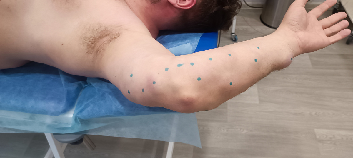 Липоматоз верхней конечности