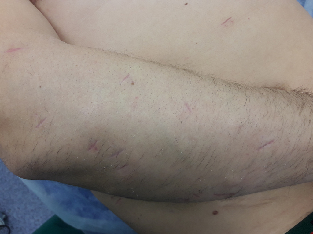 Рубцы после удаления липом при липоматозе через 2 месяца после операции