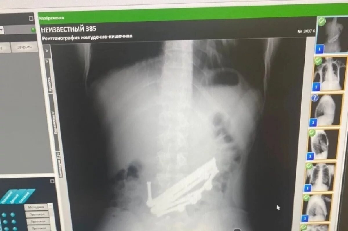    Рентген показал наличие металла.
