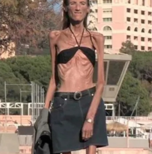 💔 Валерия Левитина: Как путь к "норме" превратился в дорогу смерти. Психология анорексии