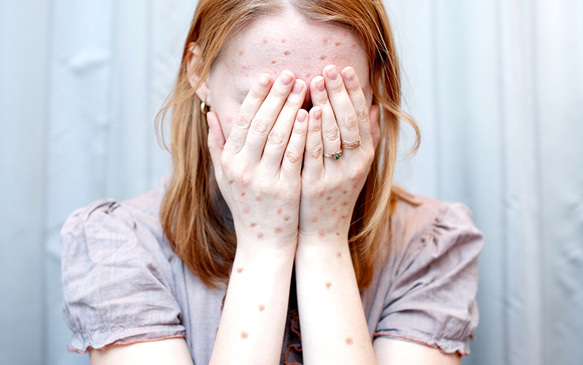    Случай кори зафиксирован в Удмуртии