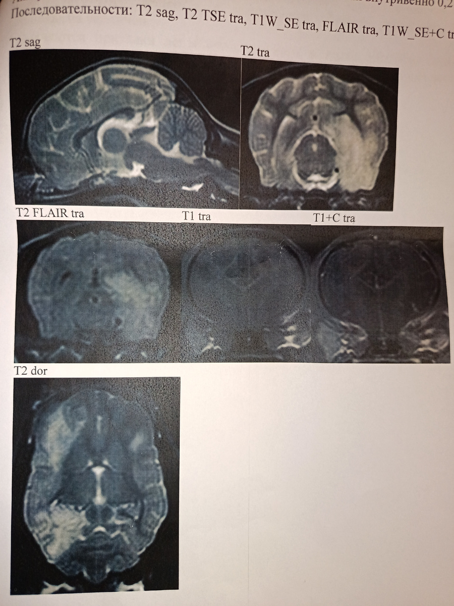 Из протокола МРТ.Белами отмечены зоны поражения. Больше всего пострадало правое полушарие. 