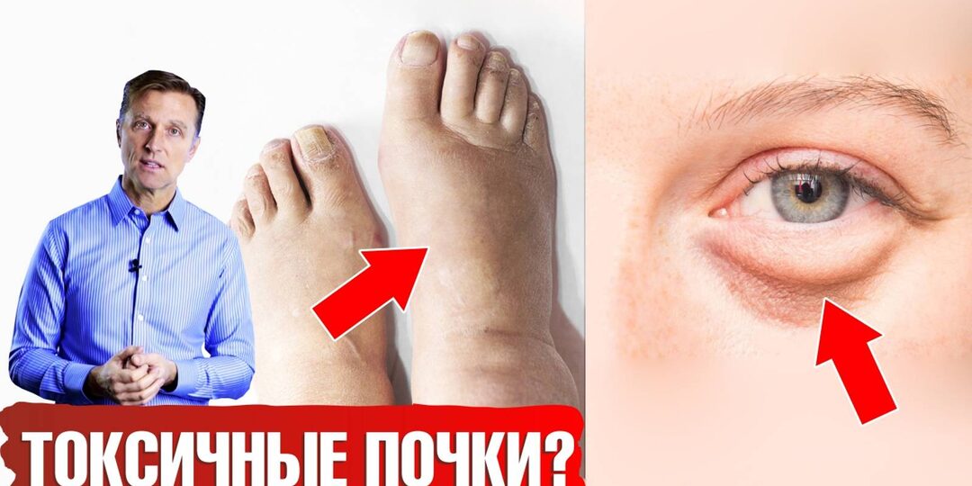 Почему появляются отёки и как это связано с почками