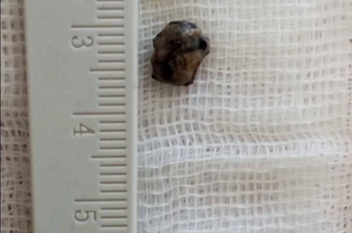    Осколок, который попал в легкое рядом с раковой опухолью.