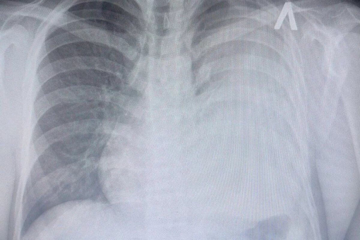    Врачи Ставрополя нашли литр жидкости в лёгких 18-летнего парня