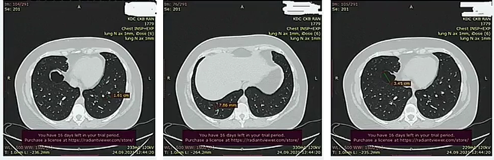 Данные инструментальных методов, КТ. Источник: личный архив доктора Ивахненко Е.Ф.