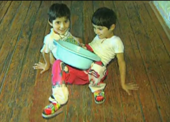 Зита и Гита Резехановы родились сросшимися нижней частью тела.