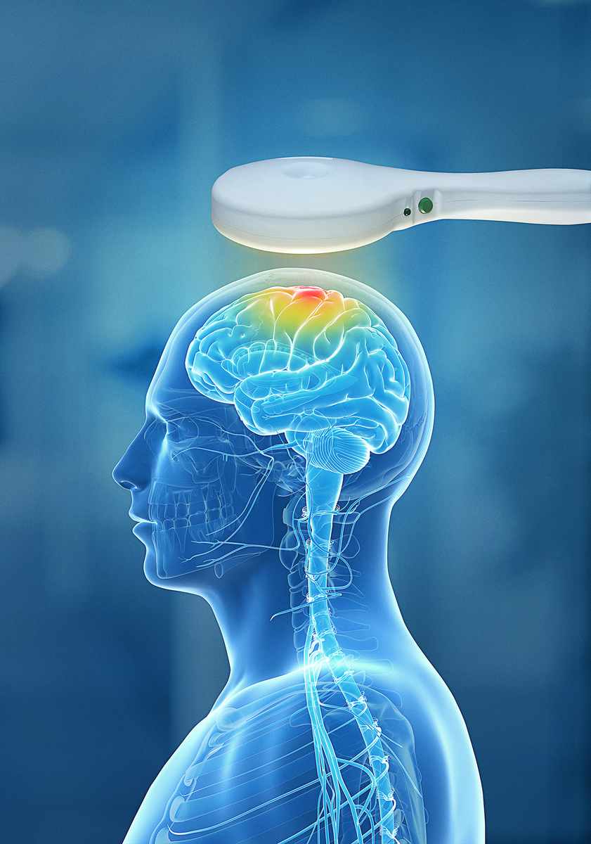 Транскраниальная магнитная стимуляции при депрессии 