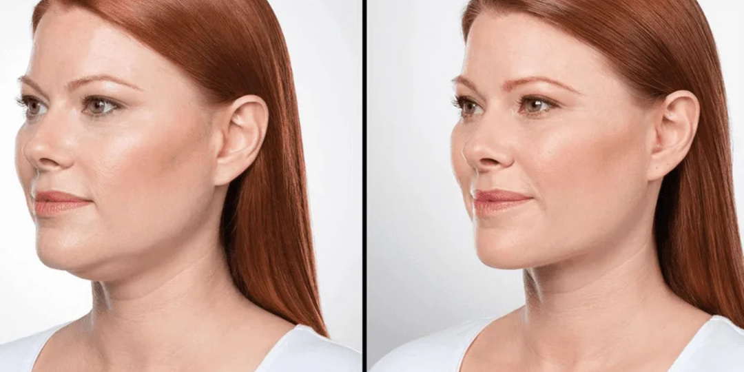 5 шагов, чтобы убрать двойной подбородок без операций