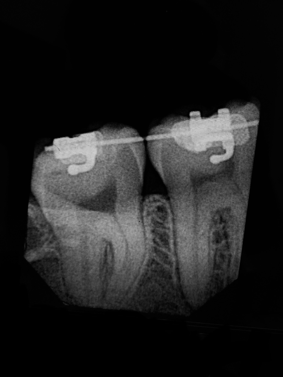Рентгеновский снимок зубов