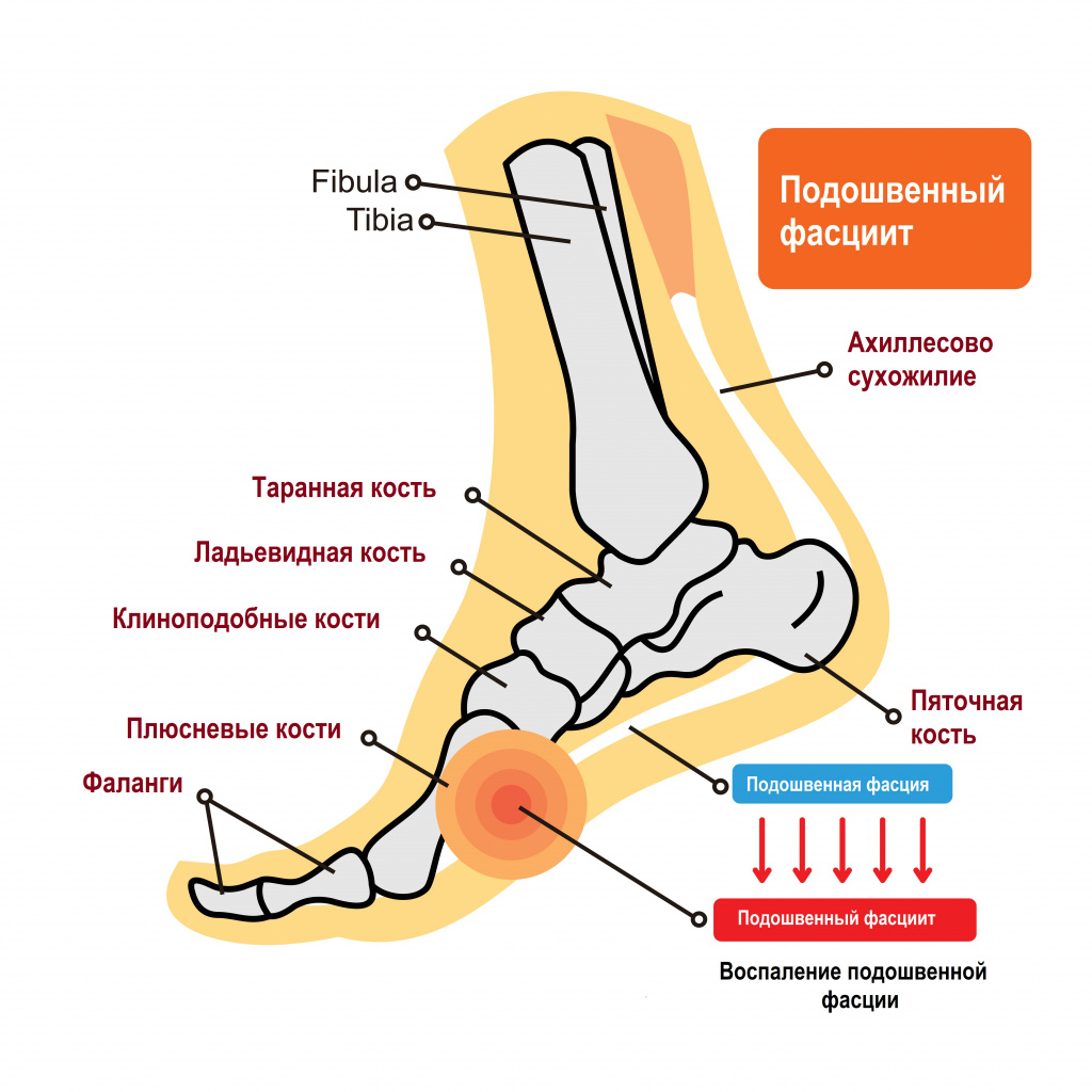 пяточная шпора